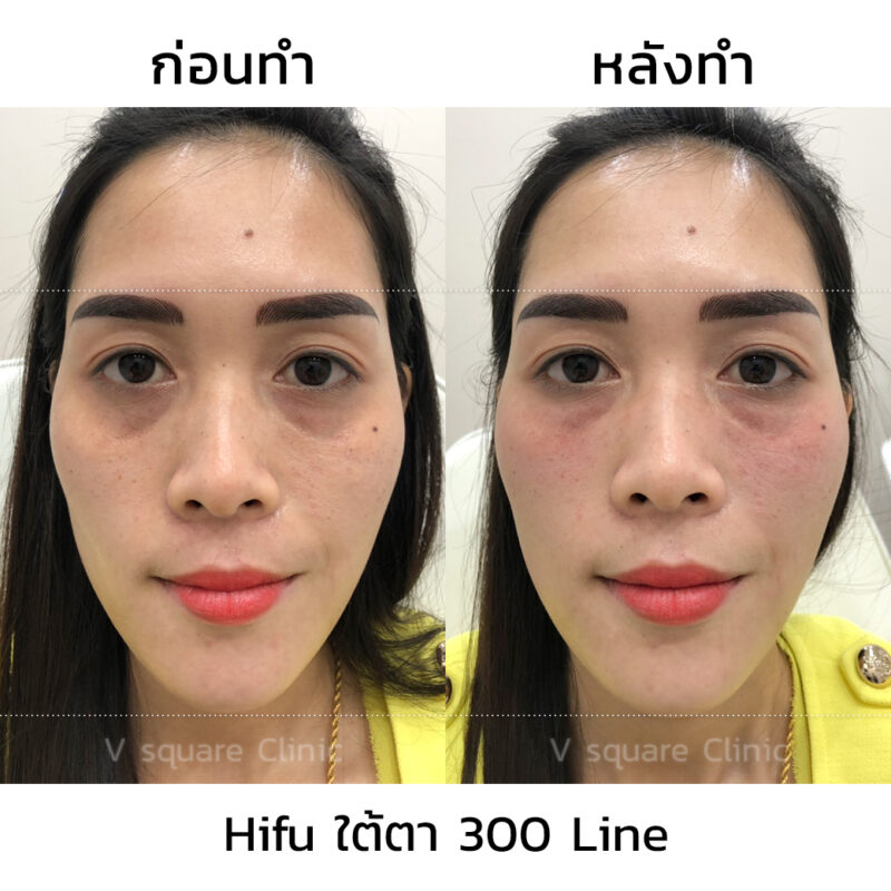 Hifu ใต้ตา-รีวิว