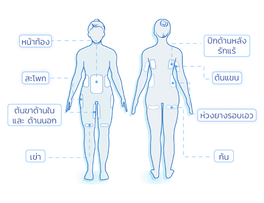 ตัวอย่างจุดที่สามารถทำ Coolsculpting