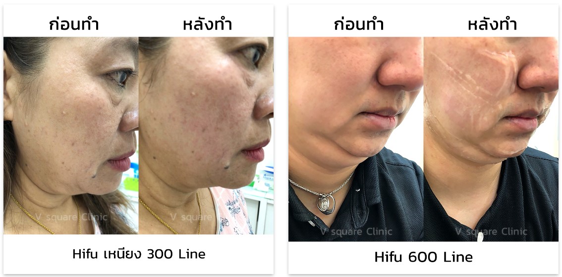 รีวิว Hifu ลดเหนียง