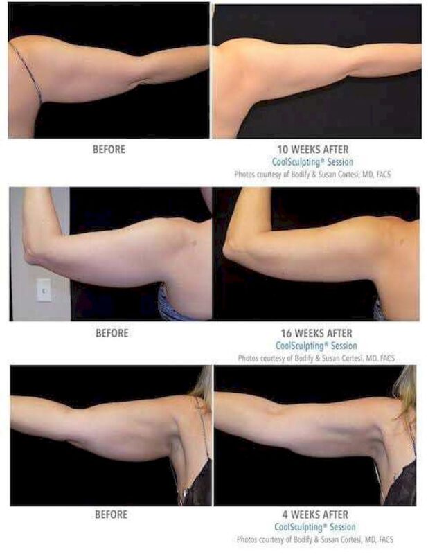 รีวิวตำแหน่งที่ทำCoolsculpting