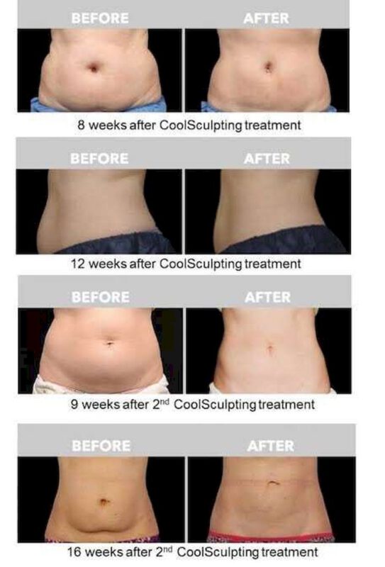 รีวิวตำแหน่งที่ทำCoolsculpting  Alt : รีวิวตำแหน่งที่ทำCoolsculpting