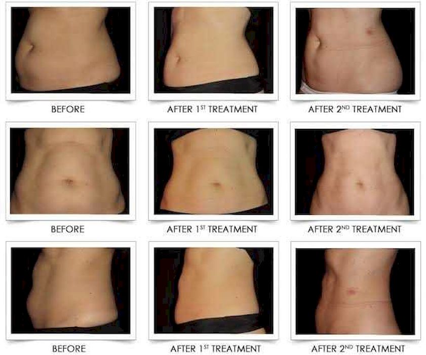 รีวิวตำแหน่งที่ทำCoolsculpting  Alt : รีวิวตำแหน่งที่ทำCoolsculpting