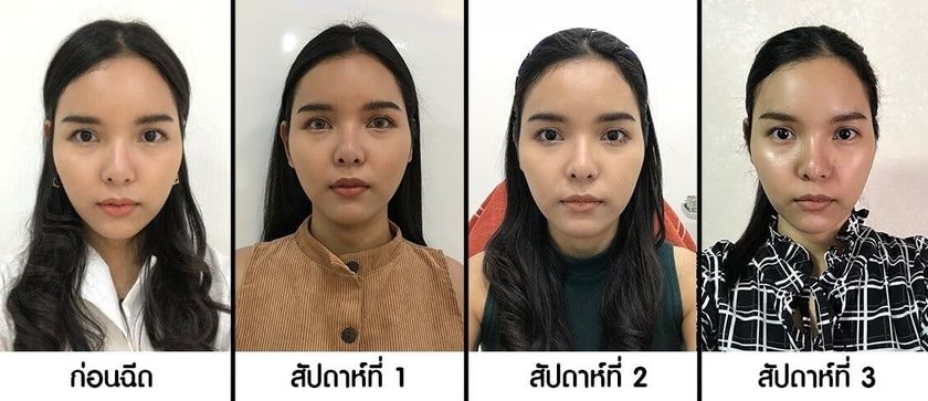 รีวิว เมโสแฟตลดแก้มหน้าเรียว ทั้ง 3 สัปดาห์