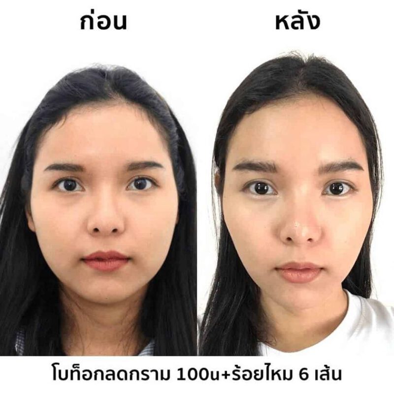 รีวิว โบท็อกลดกราม ร้อยไหม 6 เส้น