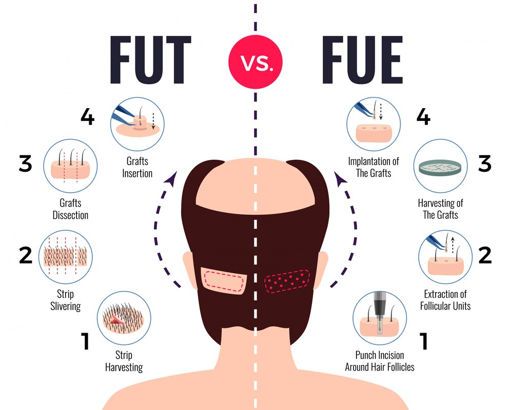 ปลูกผม FUE กับ FUT